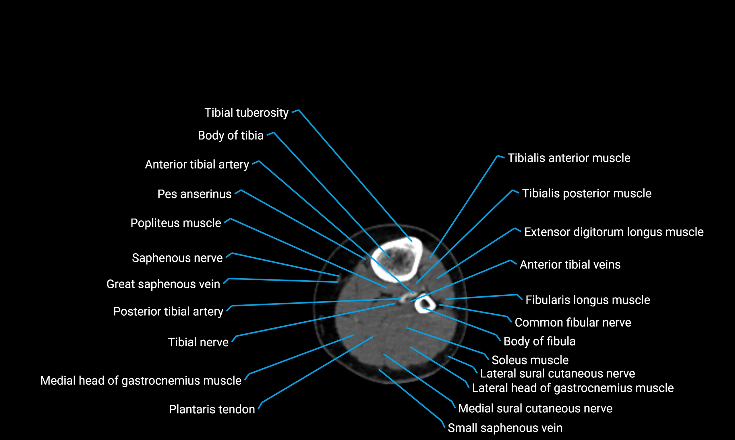 CT lower limb axial cross sectional anatomy labelled image 101 (2).webp